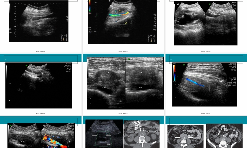 2022年医学专题—腹膜后纤维化-20131106.ppt
