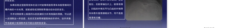 2022年医学专题—与全膝关节置换相关的髌股关节并发症.ppt