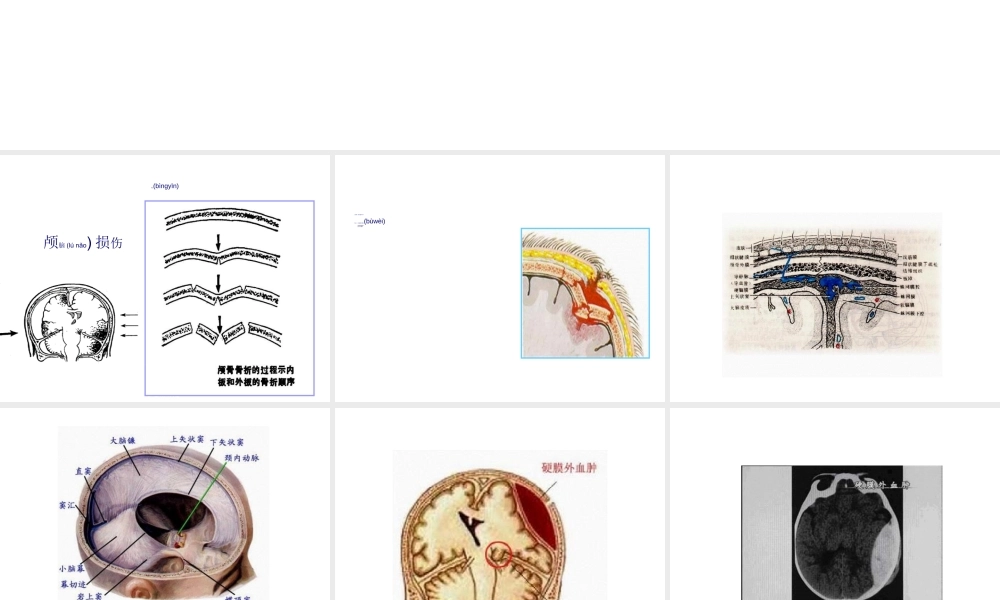 2022年医学专题—硬膜外血肿(1).ppt