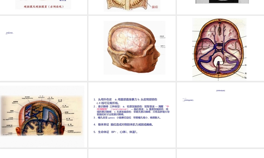 2022年医学专题—硬膜外血肿(1).ppt