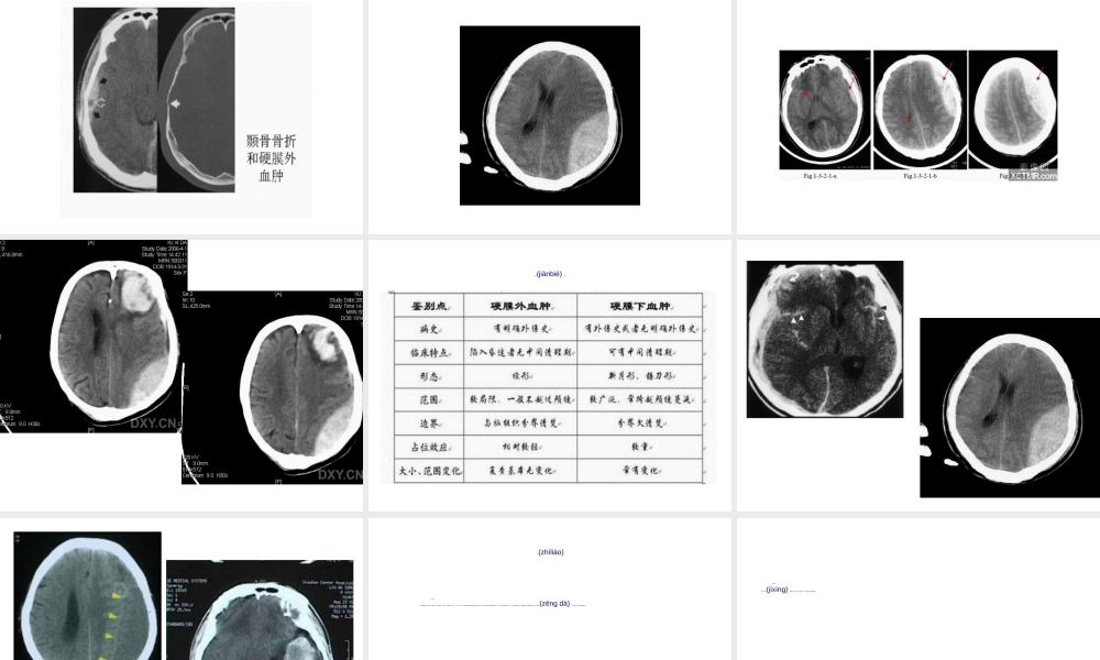2022年医学专题—硬膜外血肿(1).ppt