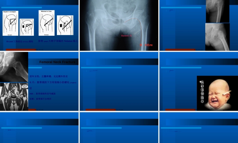 2022年医学专题—胡超华---股骨颈骨折详解(1).ppt
