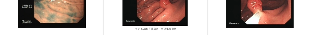 消化内镜切除术.ppt