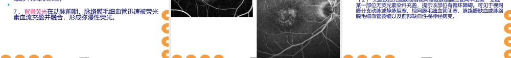 2022年医学专题—眼底血管造影.ppt