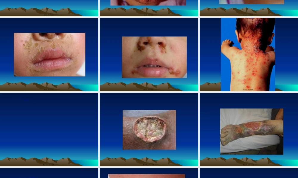 2022年医学专题—第十章细菌性皮肤病.ppt