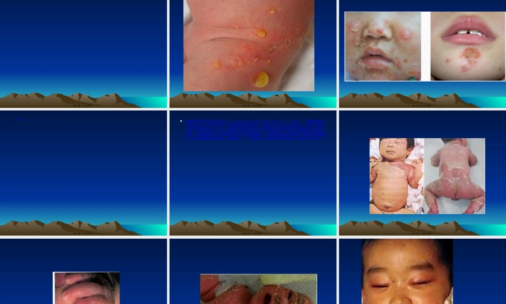 2022年医学专题—第十章细菌性皮肤病.ppt