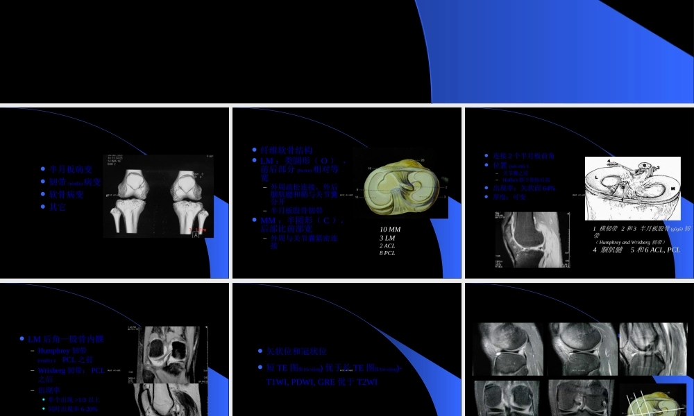 2022年医学专题—MRI膝关节(1).ppt