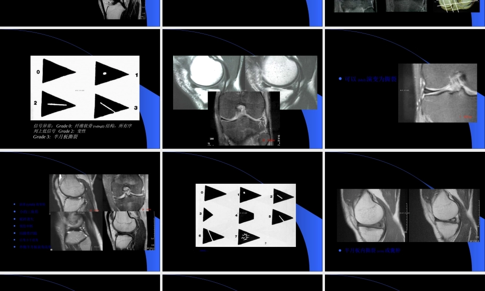 2022年医学专题—MRI膝关节(1).ppt