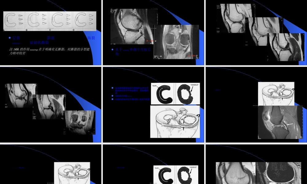 2022年医学专题—MRI膝关节(1).ppt