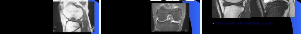 2022年医学专题—MRI膝关节(1).ppt