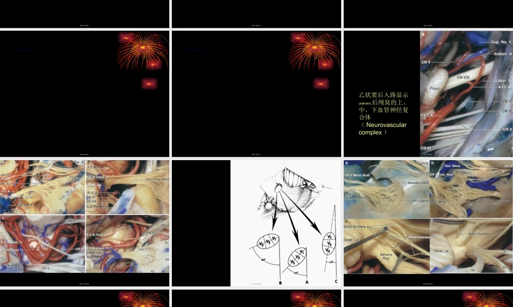 2022年医学专题—三叉神经痛1(1).ppt