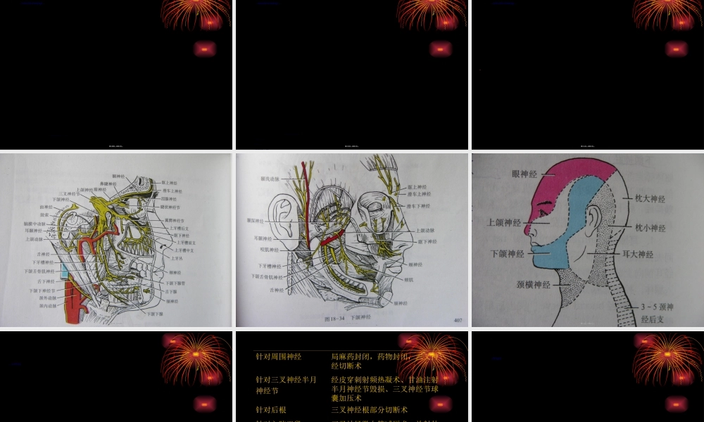 2022年医学专题—三叉神经痛1(1).ppt