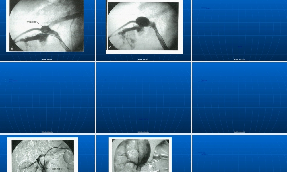 2022年医学专题—PNL的并发症(1).ppt