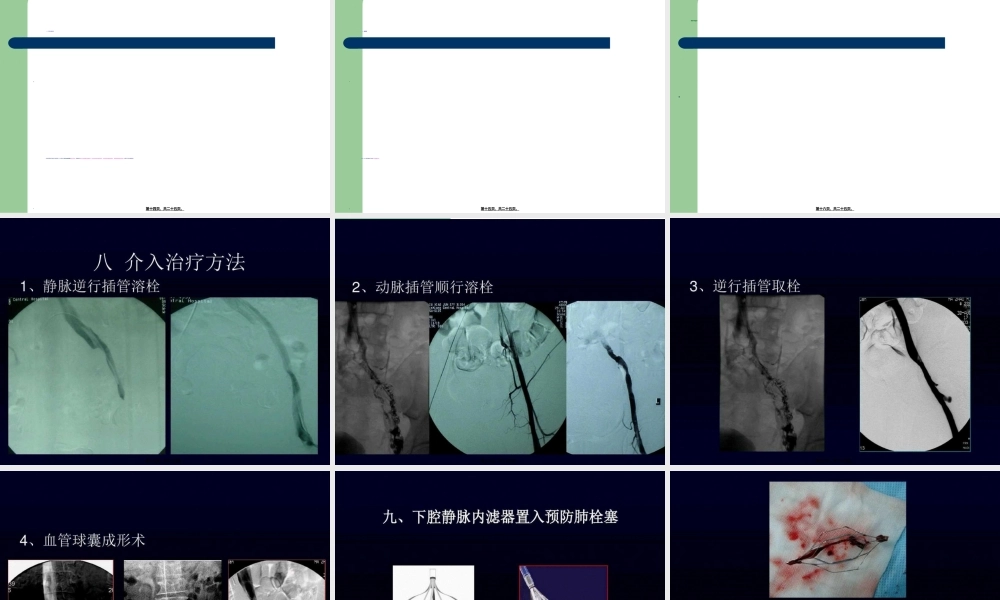 2022年医学专题—下肢深静脉血栓(1).ppt