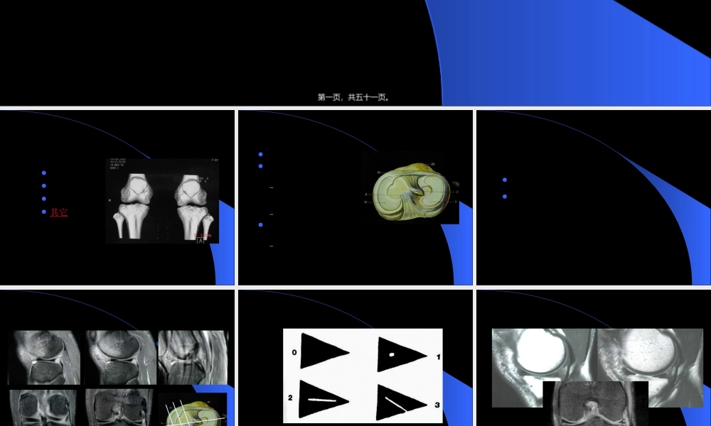 2022年医学专题—MRI在膝关节创伤的应用(1).ppt