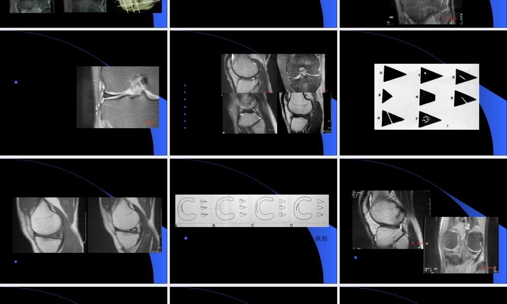 2022年医学专题—MRI在膝关节创伤的应用(1).ppt