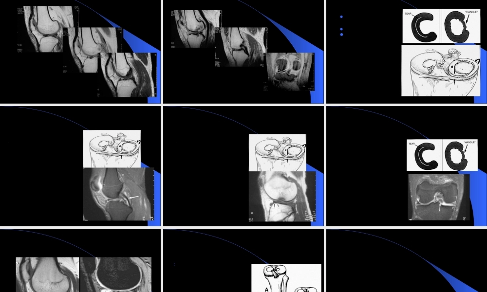 2022年医学专题—MRI在膝关节创伤的应用(1).ppt