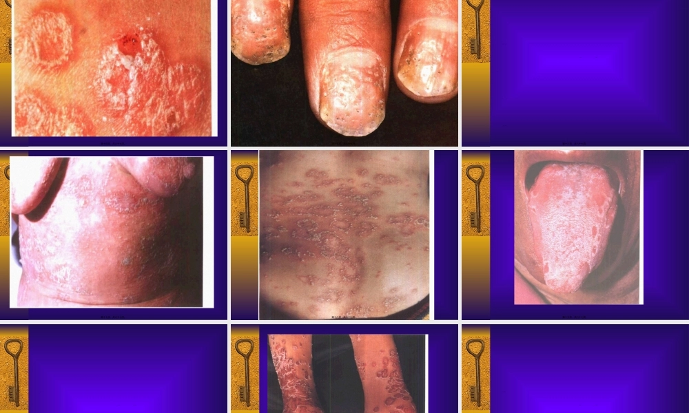 2022年医学专题—P-07红斑鳞屑性皮肤病(1).ppt