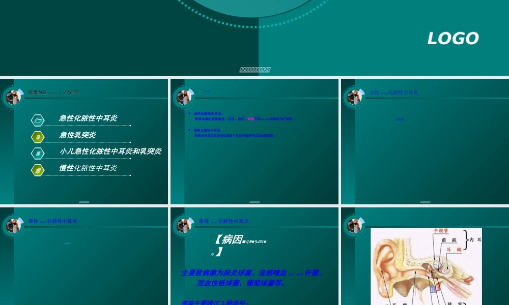 2022年医学专题—耳鼻咽喉-急慢性化脓性中耳炎-乳突炎.ppt