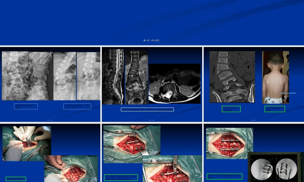 2022年医学专题—pso截骨.ppt