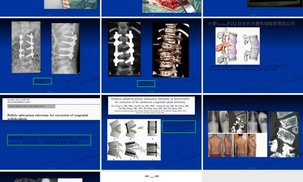 2022年医学专题—pso截骨.ppt