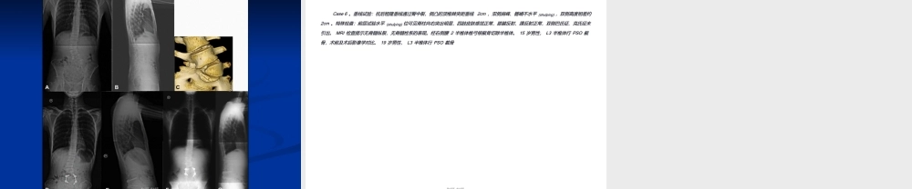 2022年医学专题—pso截骨.ppt