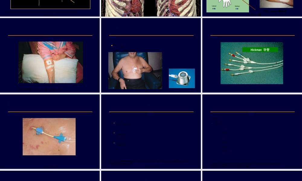2022年医学专题—Session6中心静脉导管和肠外营养并发症.ppt