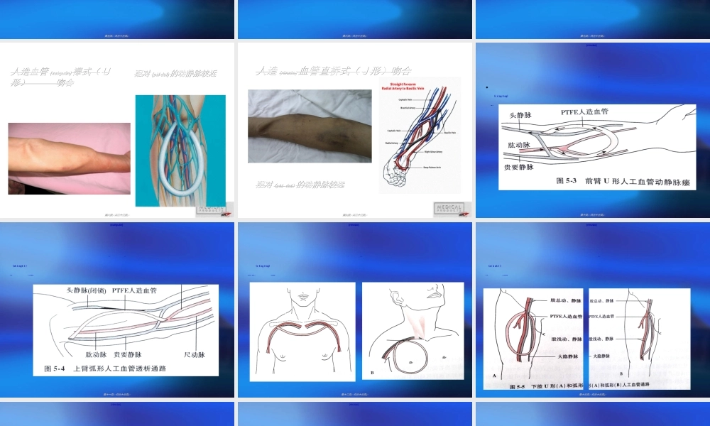 2022年医学专题—人造血管的穿刺与维护.ppt
