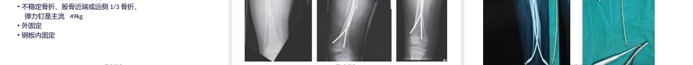 2022年医学专题—儿童股骨干骨折.pptx
