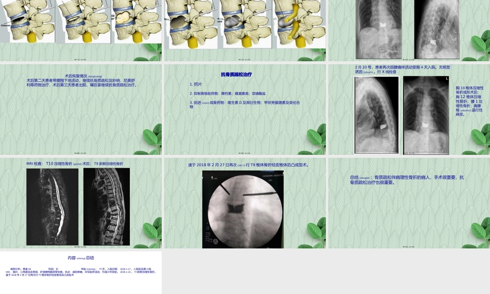 2022年医学专题—压缩性骨折病例分析.pptx