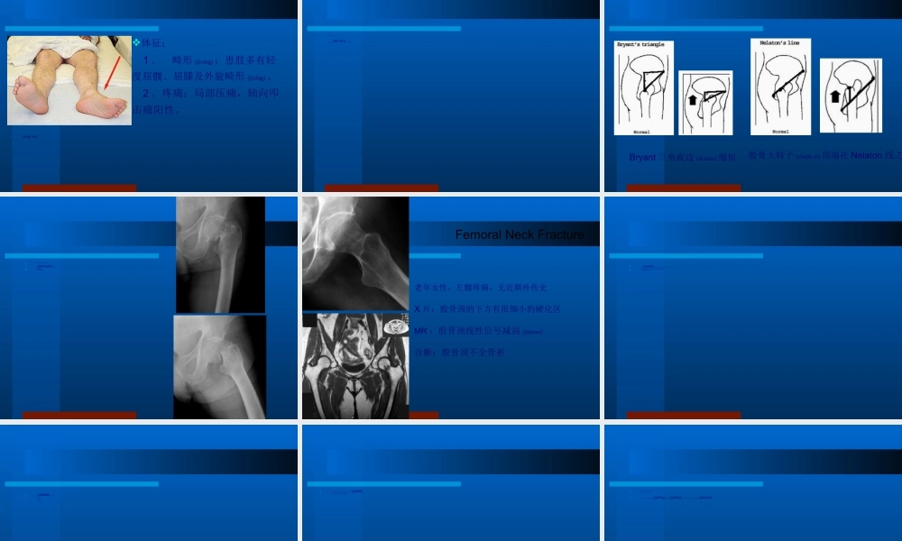 2022年医学专题—下-肢-骨-折.ppt