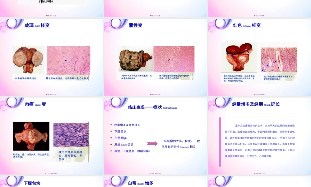 2022年医学专题—子宫肌瘤.pptx