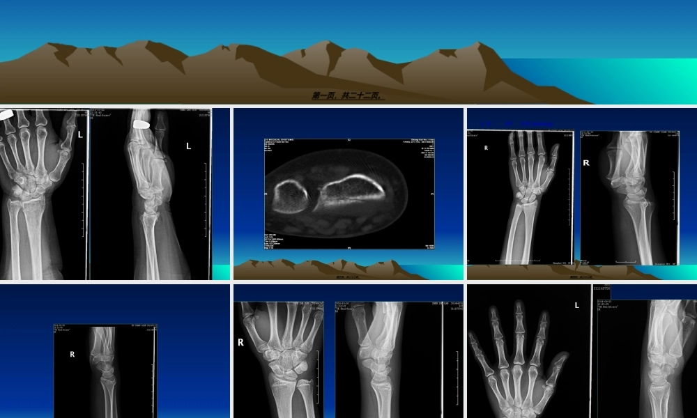 2022年医学专题—容易遗漏骨折.整理.ppt