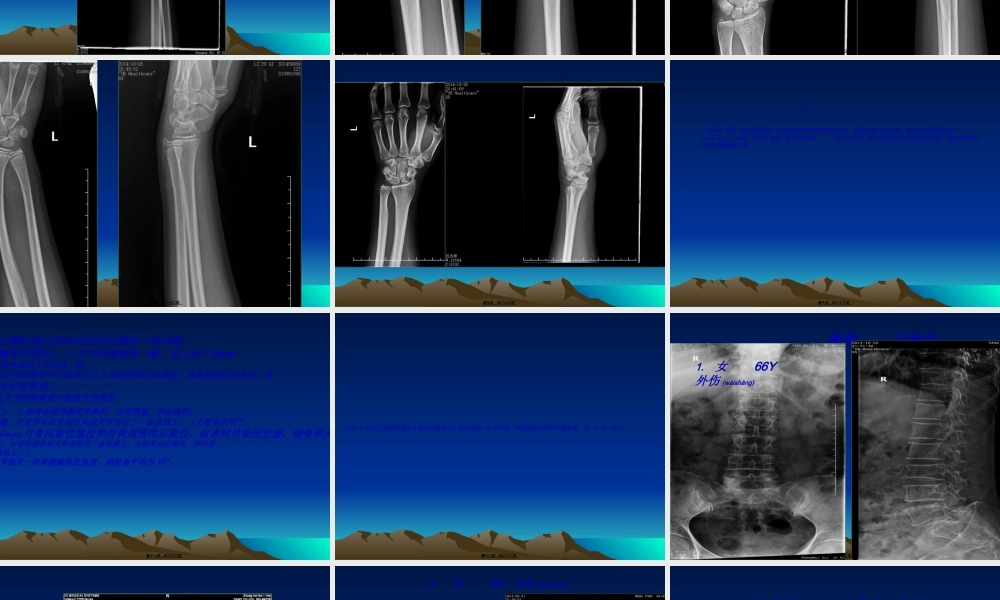 2022年医学专题—容易遗漏骨折.整理.ppt