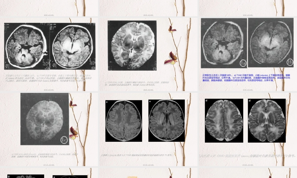 2022年医学专题—小儿脑髓鞘形成MRI.ppt