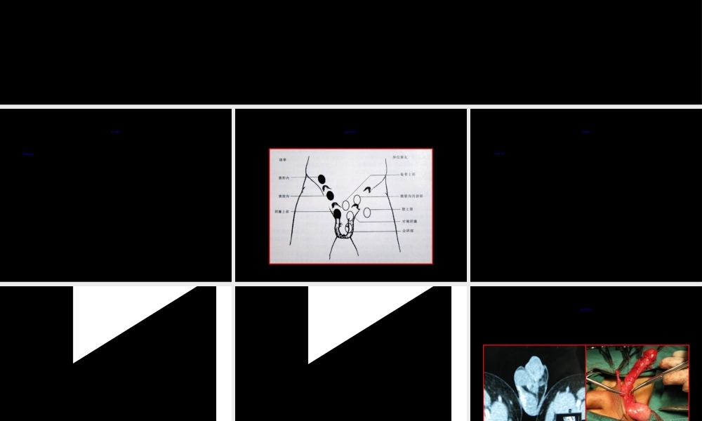 2022年医学专题—异位睾丸诊治-2011西安系列.ppt