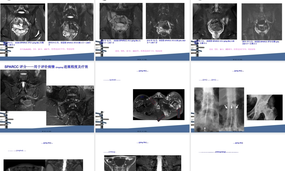 2022年医学专题—强直性脊柱炎MRI评分.ppt