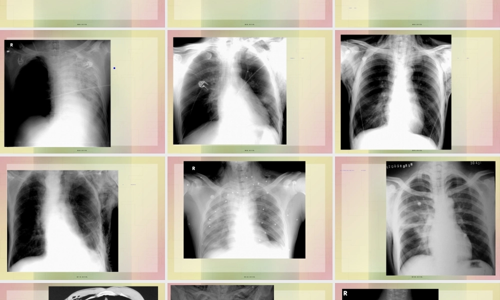 2022年医学专题—影像学-胸部外伤.ppt