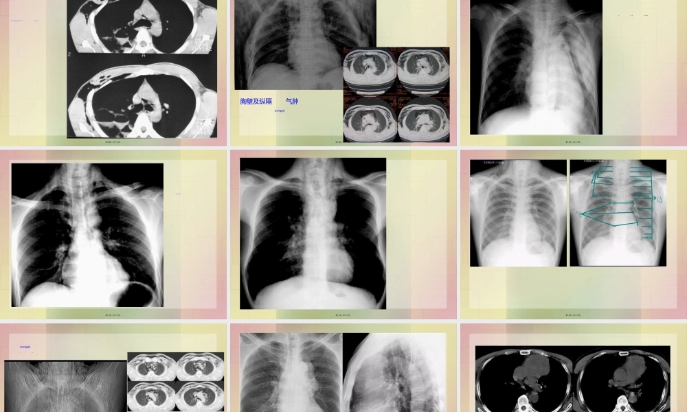 2022年医学专题—影像学-胸部外伤.ppt