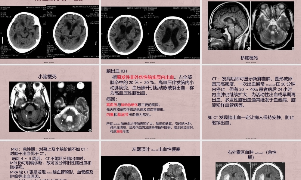 2022年医学专题—急性脑血管病.pptx