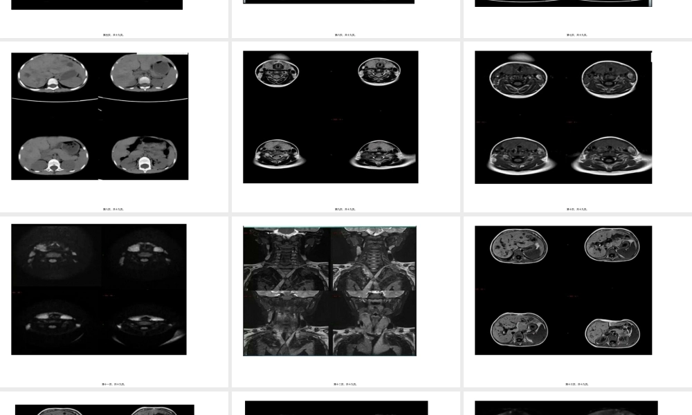 2022年医学专题—朗格罕斯细胞组织细胞增生症...ppt