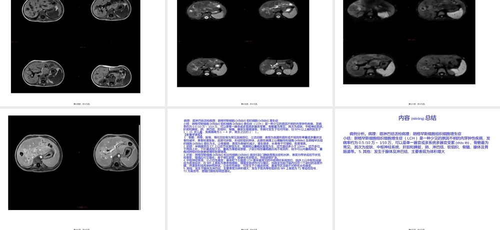 2022年医学专题—朗格罕斯细胞组织细胞增生症...ppt