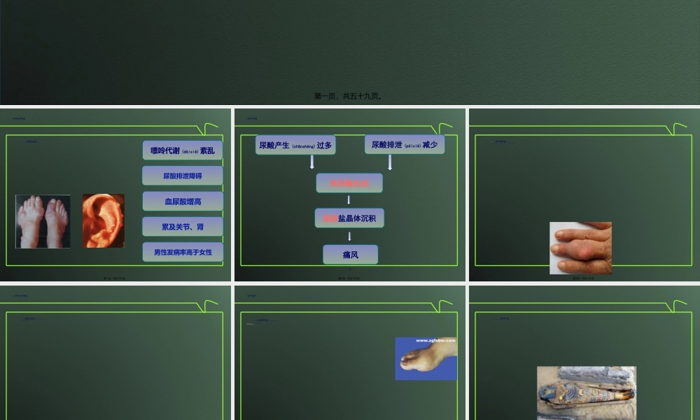 2022年医学专题—痛风.ppt