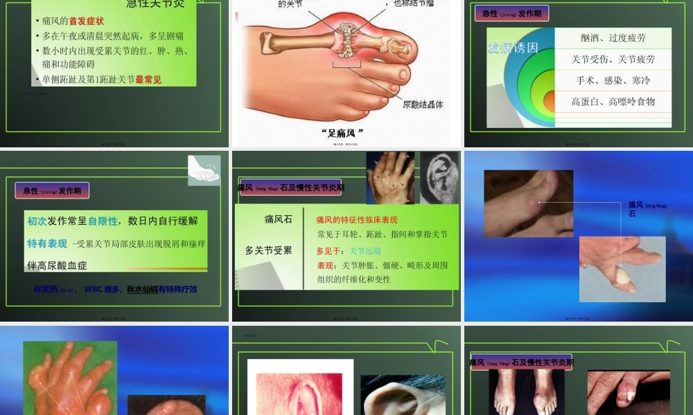 2022年医学专题—痛风.ppt