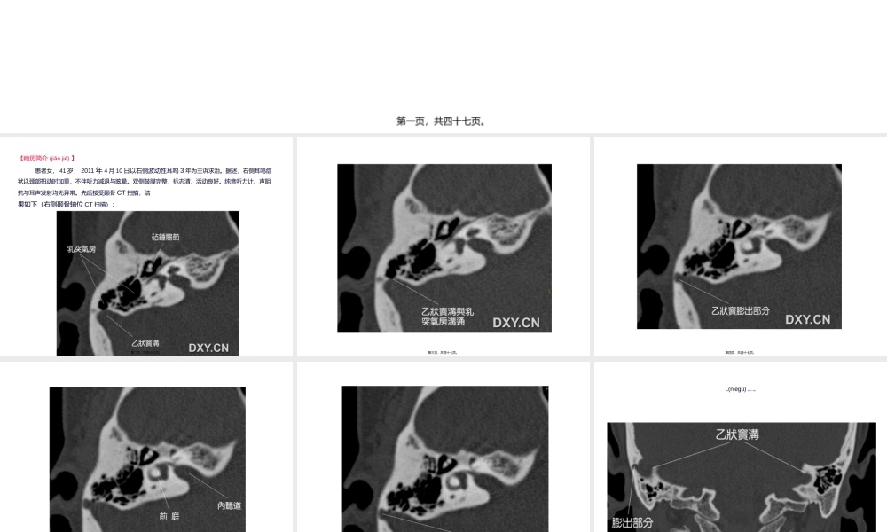 2022年医学专题—耳鸣与乙状窦憩室.ppt