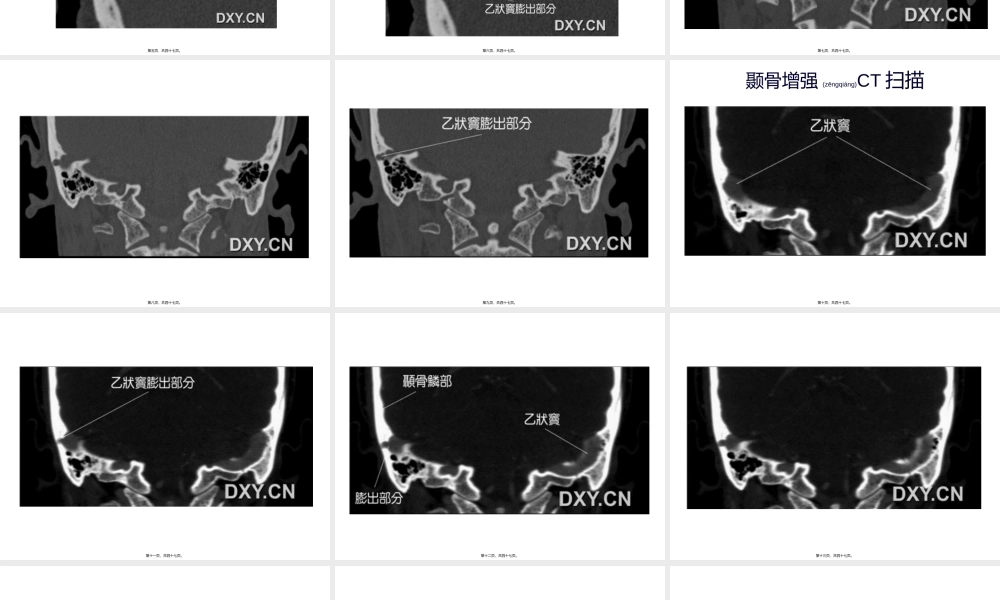 2022年医学专题—耳鸣与乙状窦憩室.ppt