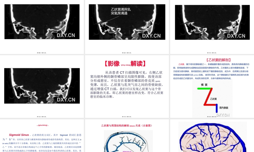 2022年医学专题—耳鸣与乙状窦憩室.ppt