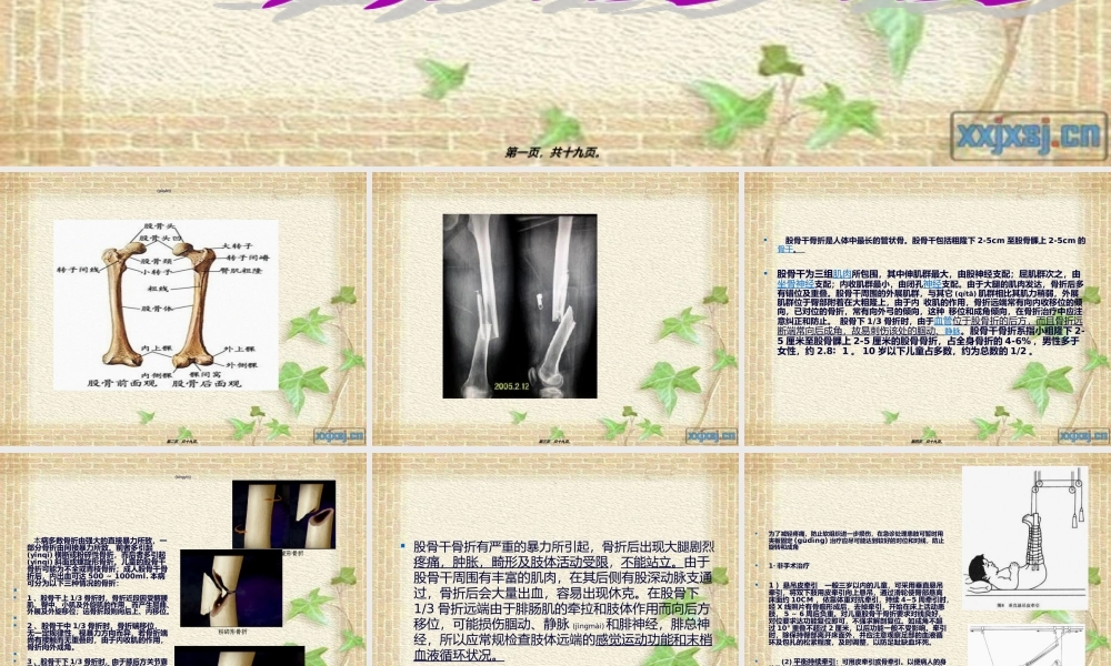 2022年医学专题—股骨干骨折(2012.10)...ppt