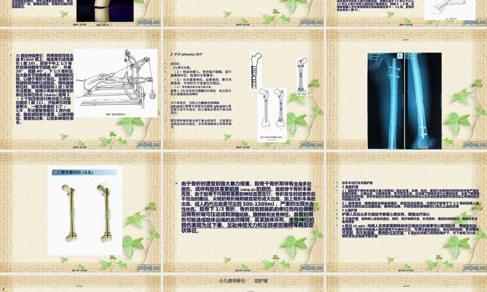 2022年医学专题—股骨干骨折(2012.10)...ppt