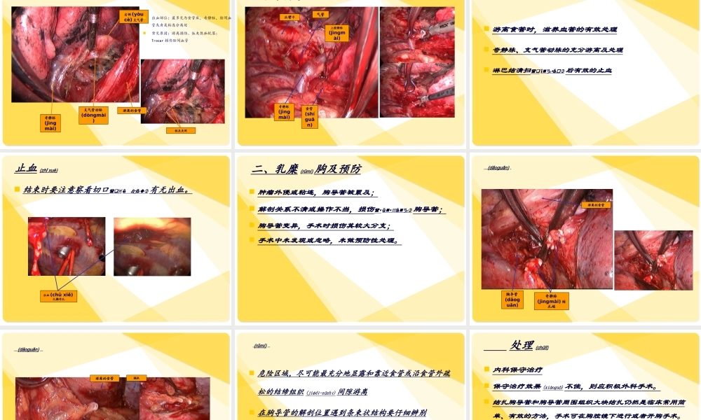 2022年医学专题—胸腔镜食管癌切除术.ppt